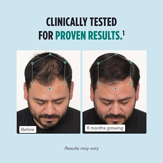 Men's Hair Growth Supplements - Clinically Tested for Thicker Hair & Scalp Coverage 1-Month Supply
